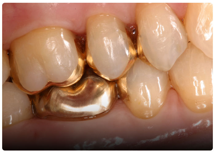 gold-in-dentistry